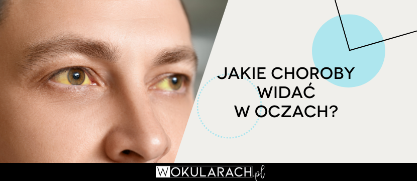 Jakie choroby widać w oczach? Sprawdź!