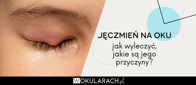 Jęczmień na oku - jak wyleczyć, jakie są jego przyczyny?