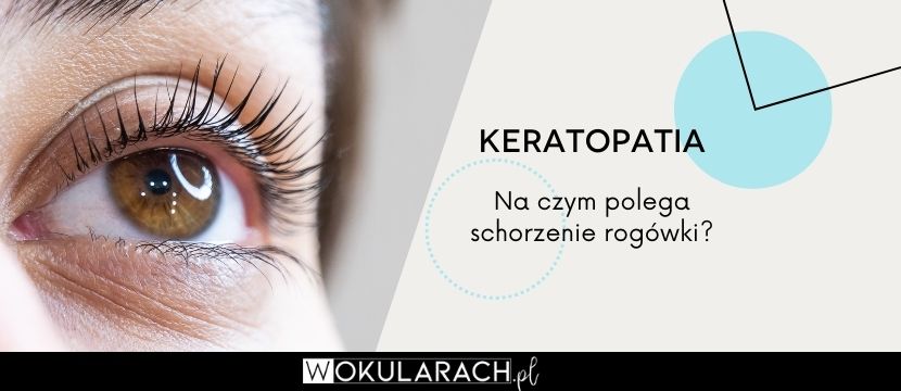 Keratopatia – na czym polega schorzenie rogówki?